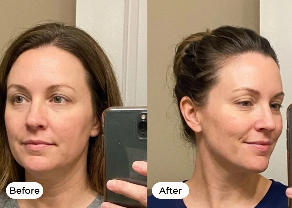 Before and after: facial puffiness drains and the jawline becomes defined