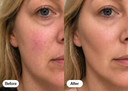 Before and after: less under-eye puffiness and calmer skin