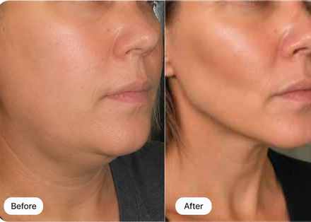 Before and after: a softer jawline becomes clearly defined